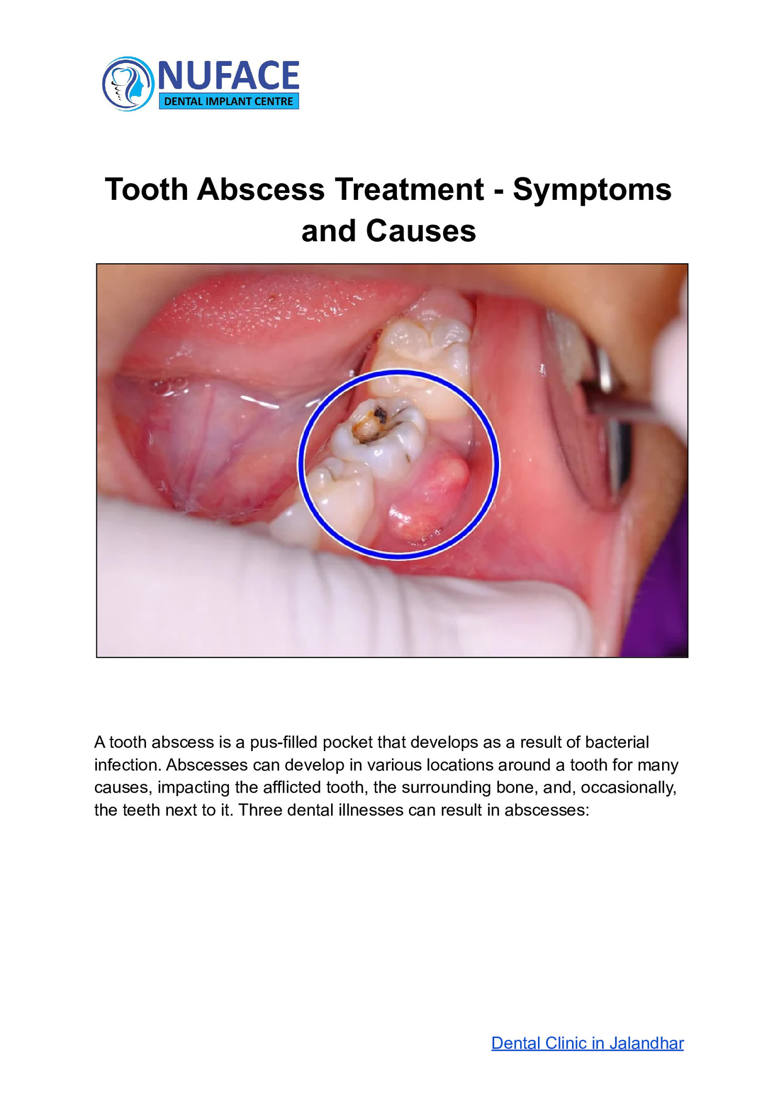Tooth Abscess Treatment - Symptoms and Causes